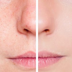 Permanent Make-up auf den Narben und Striemen